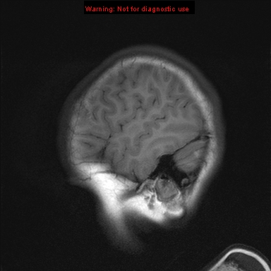 File:Neurofibromatosis type 1 with optic nerve glioma (Radiopaedia 16288-15965 Sagittal T1 21).jpg
