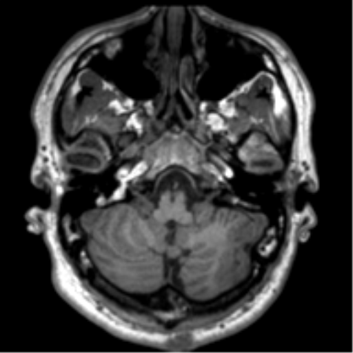 File:Neurofibromatosis type 2 (Radiopaedia 44936-48838 Axial T1 20).png