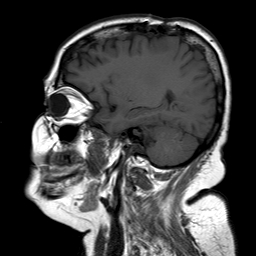 File:Neurofibromatosis type 2 (Radiopaedia 8713-9518 Sagittal T1 14).jpg