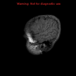File:Neurofibromatosis type 2 (Radiopaedia 8953-9730 Sagittal T1 20).jpg