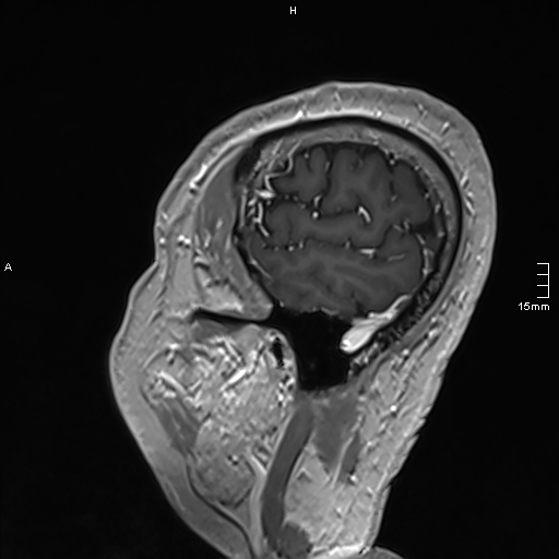 Neurosarcoidosis - involvement of the mesial temporal lobes (Radiopaedia 67429-76820 Sagittal T1 C+ 147).jpg