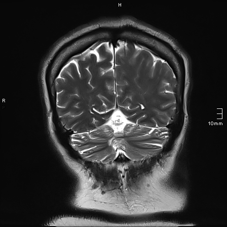 File:Neurotoxoplasmosis - concentric target sign (Radiopaedia 70644-80784 Coronal T2 13).jpg