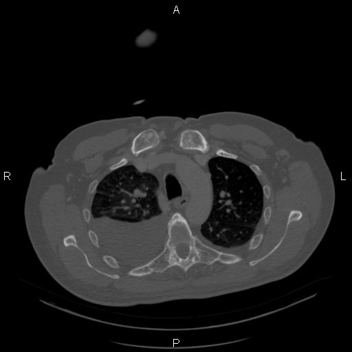 Non Hodgkin lymphoma in a patient with ankylosing spondylitis (Radiopaedia 84323-99624 Axial bone window 9).jpg