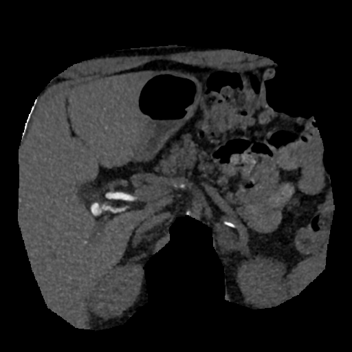 File:Normal CT intravenous cholangiogram (Radiopaedia 38199-40208 Axial IVC (MIP) 47).png