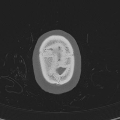 Normal CT skull (Radiopaedia 40798-43459 A 149).png