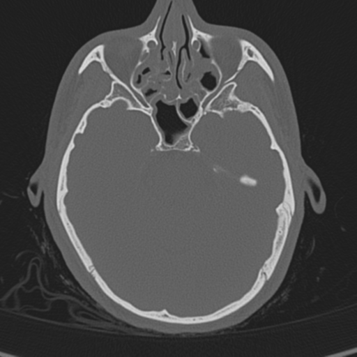 Normal CT skull (Radiopaedia 40798-43459 A 51).png