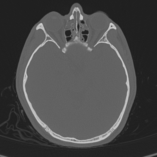 Normal CT skull (Radiopaedia 40798-43459 A 65).png