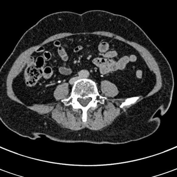 File:Normal CT split bolus study of the renal tract (Radiopaedia 48631-53634 Axial split bolus 163).jpg