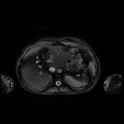 File:Normal MRI abdomen in pregnancy (Radiopaedia 88001-104541 D 11).jpg