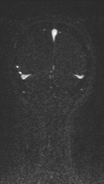 Normal MRI brain with MRV- teenager (Radiopaedia 49425-54553 Coronal MRV 204).jpg
