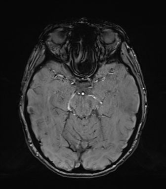 Normal brain MRI (TLE protocol) (Radiopaedia 40748-43405 Axial SWI 33).png