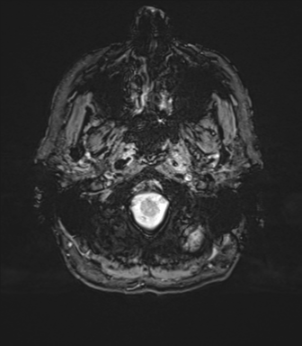 Normal brain MRI (TLE protocol) (Radiopaedia 40748-43405 Axial SWI 5).png