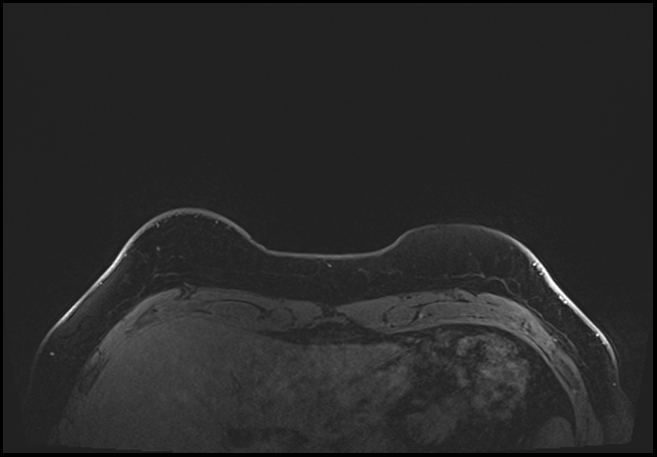 Normal breast MRI - dense breasts (Radiopaedia 80454-93850 C 14).jpg