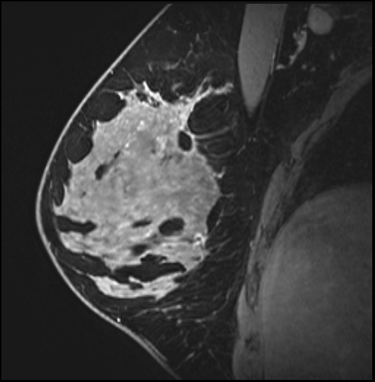 Normal breast MRI - dense breasts (Radiopaedia 80454-93850 I 76).jpg