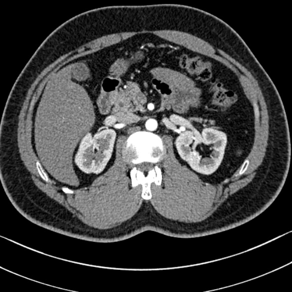 Normal kidneys on 4-phase CT study (Radiopaedia 25889-26038 B 28).jpg