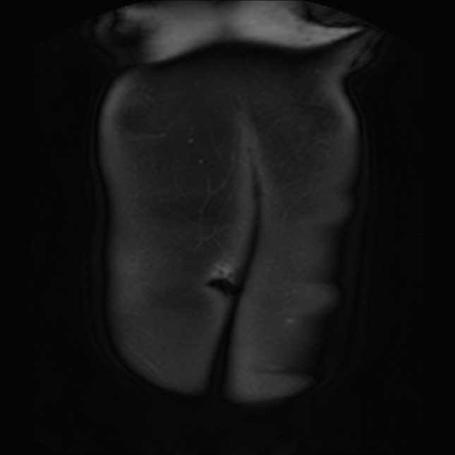 Normal liver MRI with Gadolinium (Radiopaedia 58913-66163 P 2).jpg