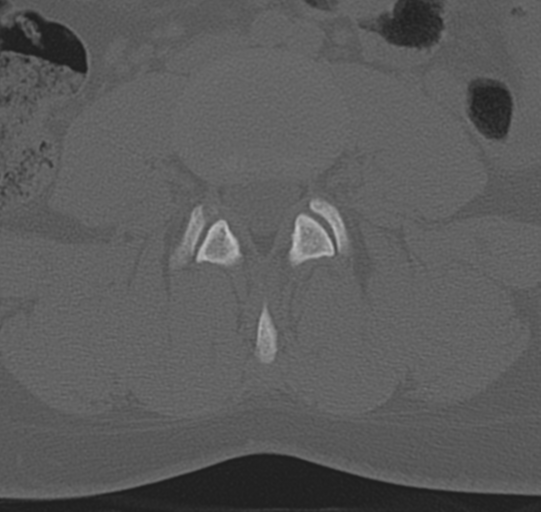 File:Normal lumbar spine CT (Radiopaedia 46533-50986 Axial bone window 42).png