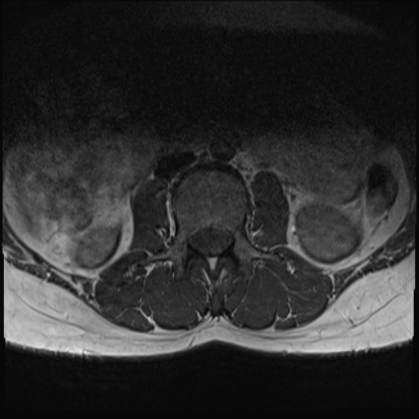 File:Normal lumbar spine MRI- 3 T (Radiopaedia 53280-59250 Axial 3).jpg