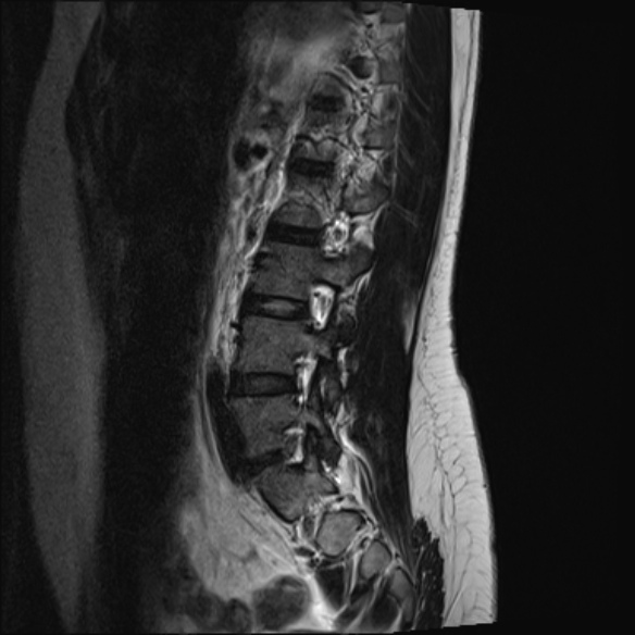 File:Normal lumbar spine MRI- 3 T (Radiopaedia 53280-59250 Sagittal T2 18).jpg