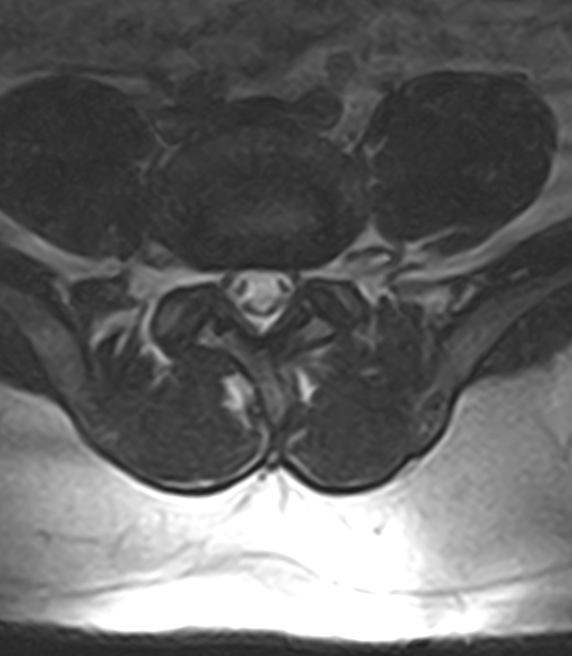 Normal lumbar spine MRI - low-field MRI scanner (Radiopaedia 40976-43699 Axial T2 75).jpg