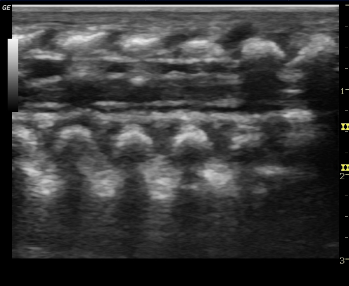 File:Normal neonatal spinal canal on ultrasound (Radiopaedia 34886-36353 Longitudinal 1).jpg