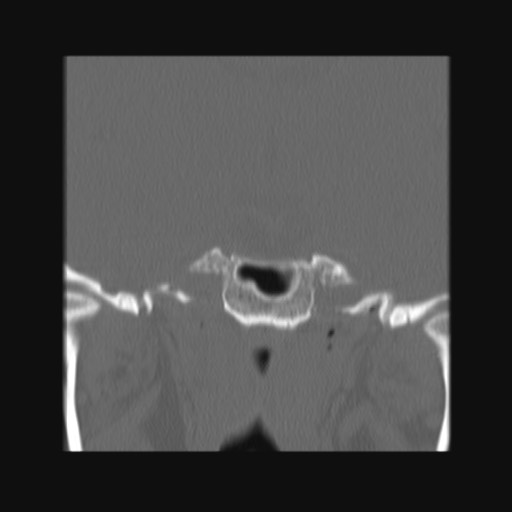 Normal sinus CT (annotated) (Radiopaedia 78917-91810 Coronal bone window 53).jpg