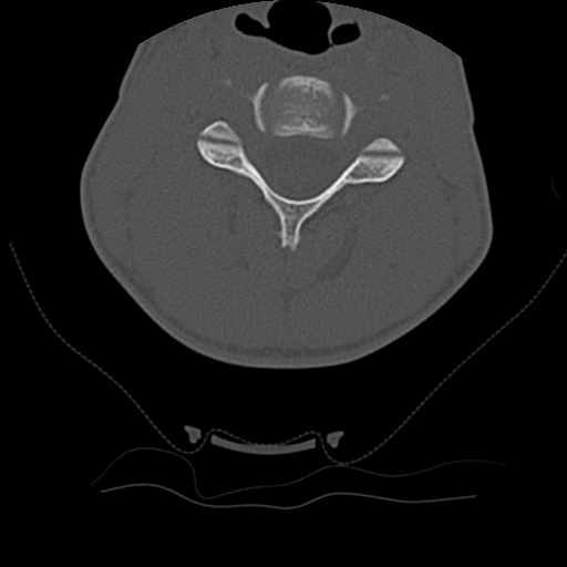 Normal trauma spine imaging (age 16) (Radiopaedia 45335-49358 Axial bone window 33).jpg