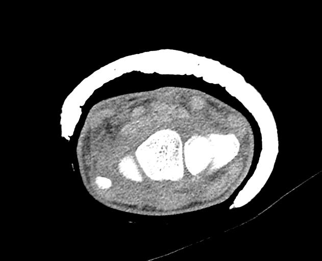 Normal wrist CT (Radiopaedia 41425-44297 Axial non-contrast 34).png