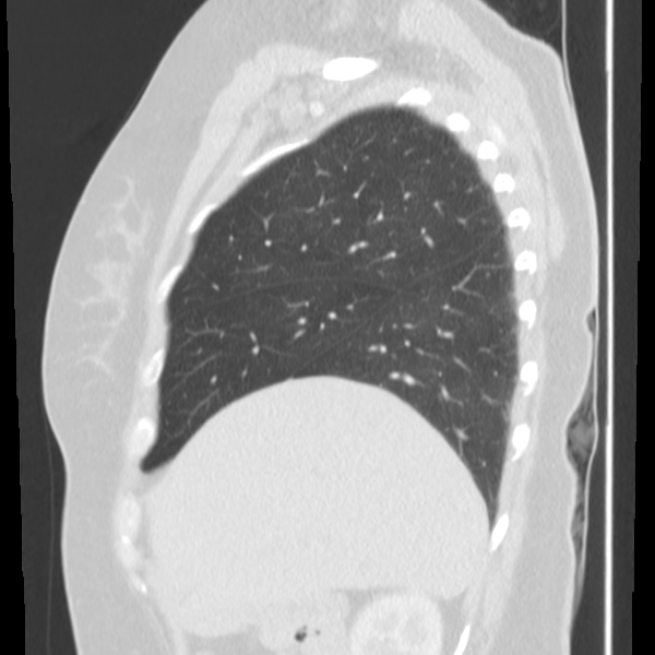 Obstructing typical carcinoid causing bronchoceles (Radiopaedia 50149-55476 Sagittal lung window 14).png