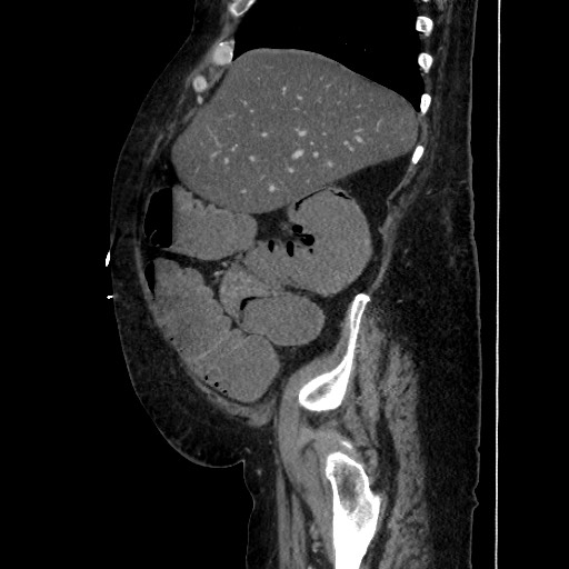Obstructive colonic diverticular stricture (Radiopaedia 81085-94675 C 66).jpg