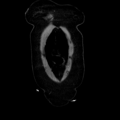 Obstructive distal colonic adenocarcinoma causing cecal perforation (Radiopaedia 86830-102989 C 39).jpg