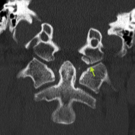 File:Occipital condyle fracture (Radiopaedia 18366-18209 Coronal 2).jpg