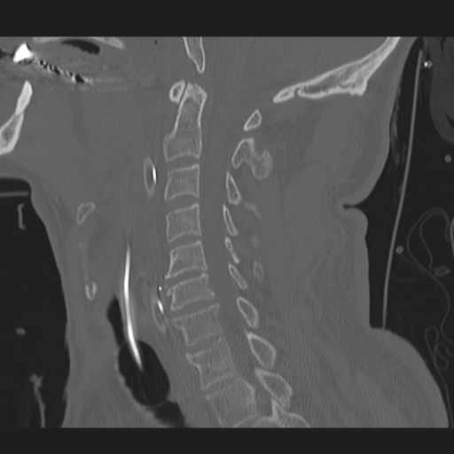 File:Occipital condyle fracture (Radiopaedia 33467-34517 Sagittal bone window 33).png