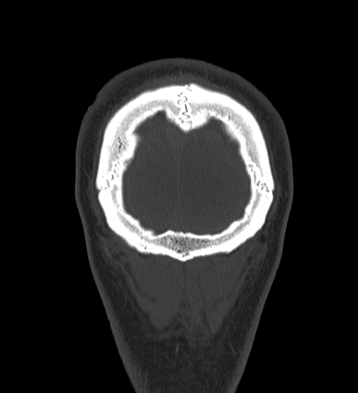 Occipital spur and Currarino type A atlas anomaly (Radiopaedia 87027-103285 Coronal bone window 135).jpg