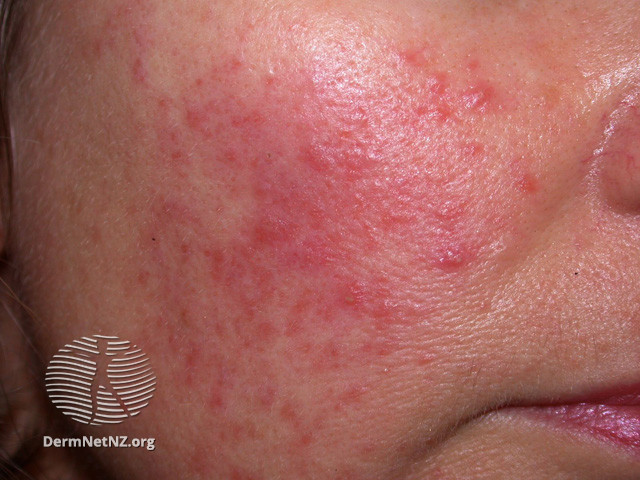 Rosacea (DermNet NZ acne-red-face-3619).jpg