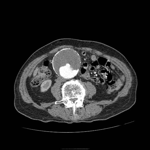 File:Abdominal aortic aneurysm (Radiopaedia 13341-13340 Axial C+ arterial phase 118).jpg