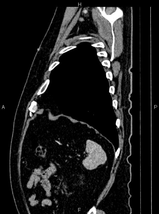 Abdominal aortic aneurysm (Radiopaedia 83094-97462 Sagittal renal cortical phase 103).jpg
