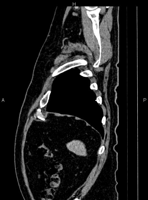Abdominal aortic aneurysm (Radiopaedia 83094-97462 Sagittal renal cortical phase 110).jpg