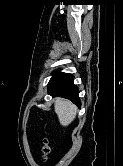 Abdominal aortic aneurysm (Radiopaedia 83094-97462 Sagittal renal cortical phase 15).jpg