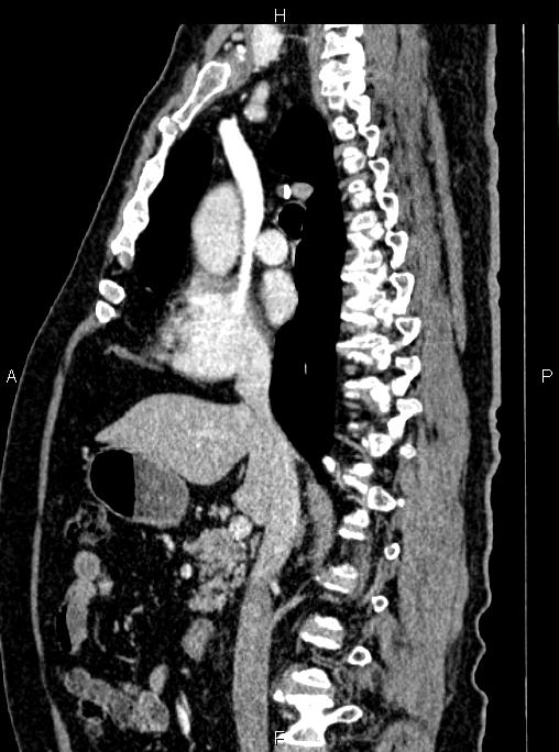 Abdominal aortic aneurysm (Radiopaedia 83094-97462 Sagittal renal cortical phase 57).jpg
