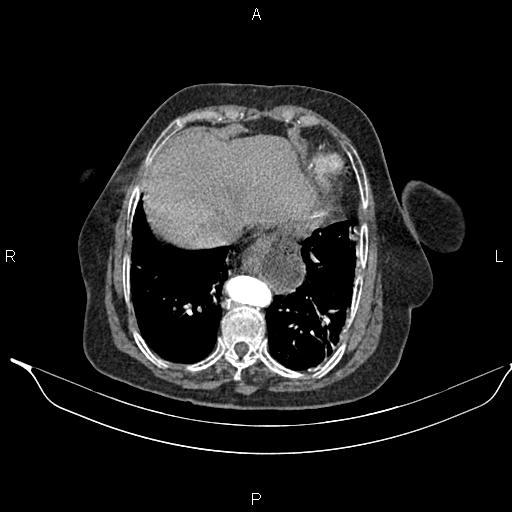 File:Abdominal aortic aneurysm (Radiopaedia 85063-100606 Axial C+ arterial phase 25).jpg