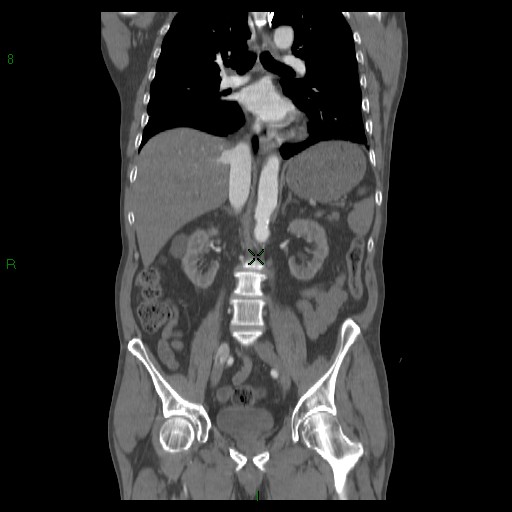 File:Abdominal aortic aneurysm rupture with aortocaval fistula (Radiopaedia 14897-14841 Coronal C+ arterial phase 27).jpg