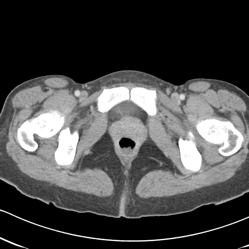 Abdominal desmoid tumor (Radiopaedia 41007-43740 Axial C+ portal venous phase 73).png