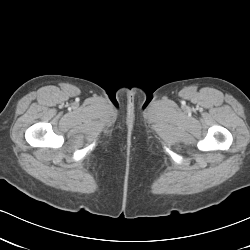 Abdominal desmoid tumor (Radiopaedia 41007-43740 Axial C+ portal venous phase 82).png