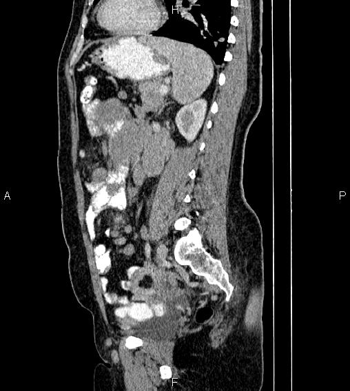 Abdominal lymphoma with sandwich sign (Radiopaedia 84378-99704 Sagittal C+ portal venous phase 59).jpg