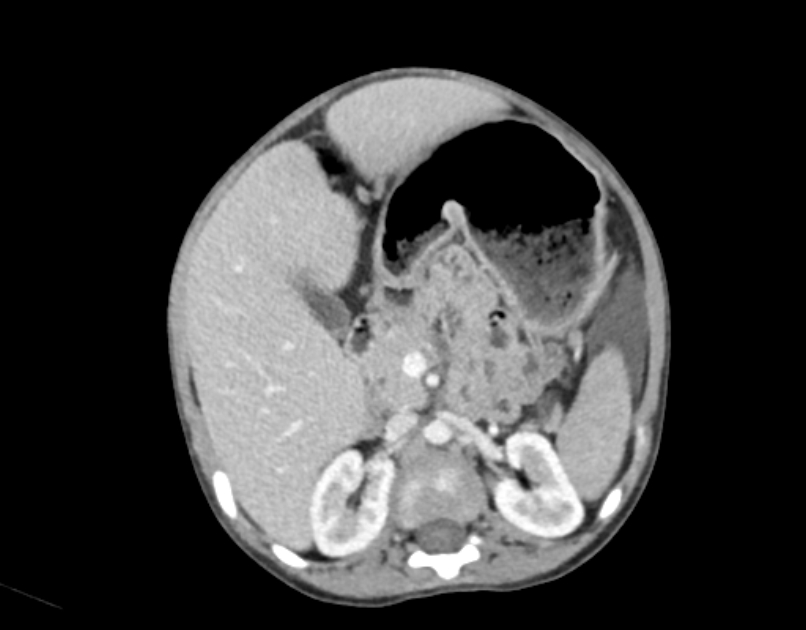 Abdominal premesenteric cystic lymphangioma (Radiopaedia 82995-97350 Axial C+ portal venous phase 21).jpg