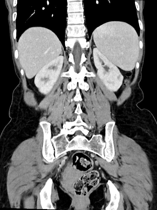 Abdominal wall and retroperitoneal tuberculosis (Radiopaedia 88137-104729 Coronal C+ portal venous phase 75).jpg