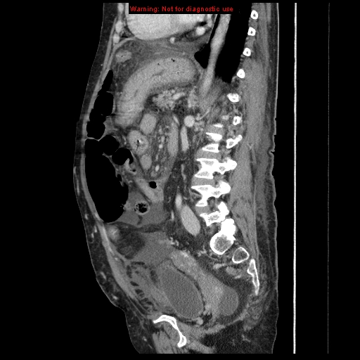 Abdominal wall hematoma (Radiopaedia 9427-10112 Sagittal C+ portal venous phase 44).jpg