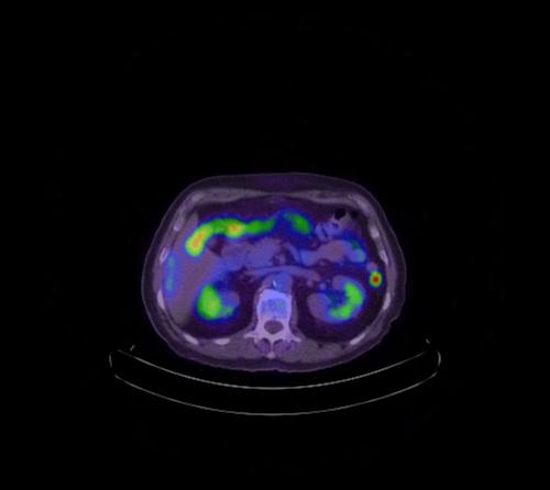 Abdominal wall metastasis from colorectal carcinoma (Radiopaedia 31016-31719 Axial 75).jpg
