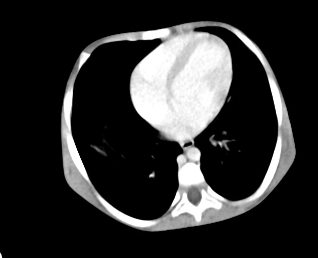 Abdominopelvic rhabdomyosarcoma (Radiopaedia 78356-90984 Axial C+ portal venous phase 30).jpg